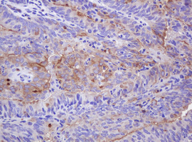 ABCB1 / MDR1 / P Glycoprotein Antibody - IHC of paraffin-embedded Adenocarcinoma of Human endometrium tissue using anti-ABCB1 mouse monoclonal antibody. (Heat-induced epitope retrieval by 10mM citric buffer, pH6.0, 120°C for 3min).