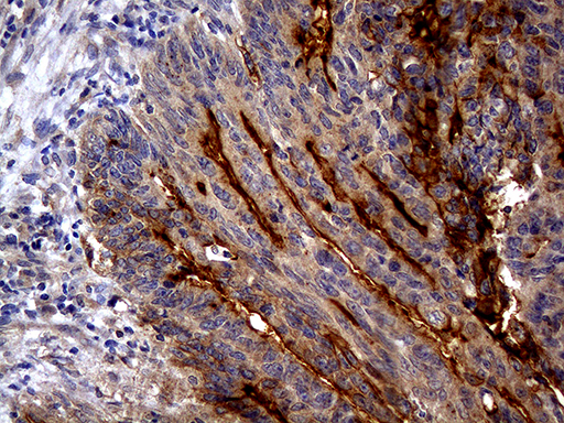ABCB1 / MDR1 / P Glycoprotein Antibody - Immunohistochemical staining of paraffin-embedded Adenocarcinoma of Human colon tissue using anti-ABCB1 mouse monoclonal antibody. (Heat-induced epitope retrieval by 1mM EDTA in 10mM Tris buffer. (pH8.5) at 120°C for 3 min. (1:150)