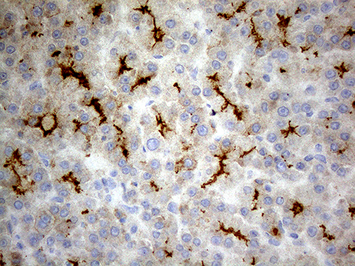ABCB1 / MDR1 / P Glycoprotein Antibody - Immunohistochemical staining of paraffin-embedded Carcinoma of Human liver tissue using anti-ABCB1 mouse monoclonal antibody. (Heat-induced epitope retrieval by 1mM EDTA in 10mM Tris buffer. (pH8.5) at 120°C for 3 min. (1:150)