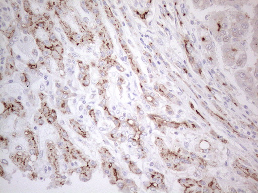 ABCB1 / MDR1 / P Glycoprotein Antibody - Immunohistochemical staining of paraffin-embedded Carcinoma of Human liver tissue using anti-ABCB1 mouse monoclonal antibody. (Heat-induced epitope retrieval by 1mM EDTA in 10mM Tris buffer. (pH8.5) at 120°C for 3 min. (1:150)