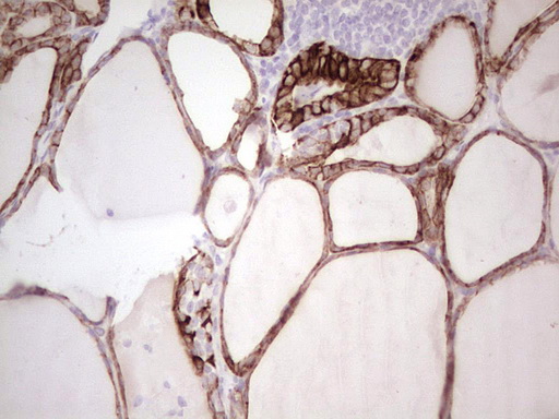 ABCB1 / MDR1 / P Glycoprotein Antibody - Immunohistochemical staining of paraffin-embedded Human thyroid tissue within the normal limits using anti-ABCB1 mouse monoclonal antibody. (Heat-induced epitope retrieval by 1 mM EDTA in 10mM Tris, pH8.5, 120C for 3min,