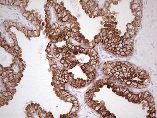 ABCB1 / MDR1 / P Glycoprotein Antibody - Immunohistochemical staining of paraffin-embedded Human prostate tissue within the normal limits using anti-ABCB1 mouse monoclonal antibody. (Heat-induced epitope retrieval by 1 mM EDTA in 10mM Tris, pH8.5, 120C for 3min,