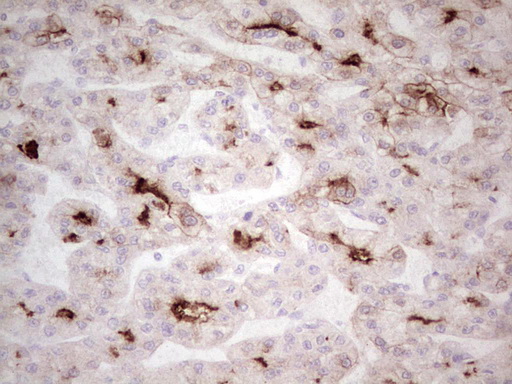 ABCB1 / MDR1 / P Glycoprotein Antibody - Immunohistochemical staining of paraffin-embedded Carcinoma of Human liver tissue using anti-ABCB1 mouse monoclonal antibody. (Heat-induced epitope retrieval by 1 mM EDTA in 10mM Tris, pH8.5, 120C for 3min,