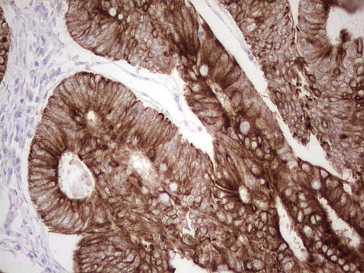 ABCB1 / MDR1 / P Glycoprotein Antibody - IHC of paraffin-embedded Adenocarcinoma of Human colon tissue using anti-ABCB1 mouse monoclonal antibody. (Heat-induced epitope retrieval by 1 mM EDTA in 10mM Tris, pH8.5, 120°C for 3min).