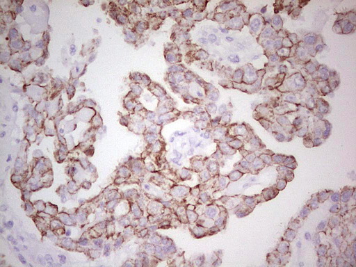 ABCB1 / MDR1 / P Glycoprotein Antibody - IHC of paraffin-embedded Adenocarcinoma of Human ovary tissue using anti-ABCB1 mouse monoclonal antibody. (Heat-induced epitope retrieval by 1 mM EDTA in 10mM Tris, pH8.5, 120°C for 3min).