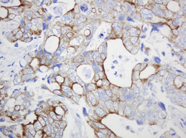 ABCB1 / MDR1 / P Glycoprotein Antibody - IHC of paraffin-embedded Adenocarcinoma of Human breast tissue using anti-ABCB1 mouse monoclonal antibody.