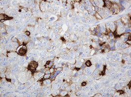 ABCB1 / MDR1 / P Glycoprotein Antibody - IHC of paraffin-embedded Adenocarcinoma of Human colon tissue using anti-ABCB1 mouse monoclonal antibody.