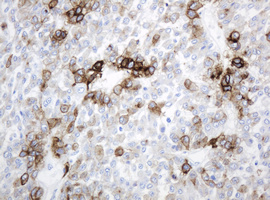 ABCB1 / MDR1 / P Glycoprotein Antibody - IHC of paraffin-embedded Carcinoma of Human liver tissue using anti-ABCB1 mouse monoclonal antibody.