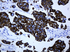 ABCB1 / MDR1 / P Glycoprotein Antibody - IHC of paraffin-embedded Carcinoma of Human bladder tissue using anti-ABCB1 mouse monoclonal antibody.