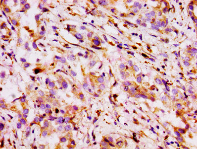 ABCB1 / MDR1 / P Glycoprotein Antibody - Immunohistochemistry of paraffin-embedded human liver cancer using ABCB1 Antibody at dilution of 1:100