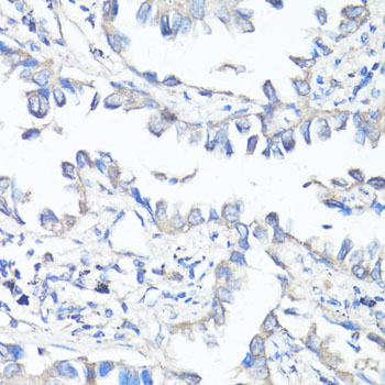 ABCB1 / MDR1 / P Glycoprotein Antibody - Immunohistochemistry of paraffin-embedded human lung cancer using ABCB1 antibody at dilution of 1:100 (40x lens).