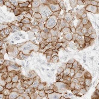 ABCB1 / MDR1 / P Glycoprotein Antibody - Immunohistochemistry of paraffin-embedded human liver cancer tissue slide using P glycoprotein antibody at dilution of 1:500
