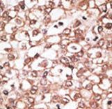 ABCB11 / BSEP Antibody - Formalin-fixed and paraffin-embedded human cancer tissue reacted with the primary antibody, which was peroxidase-conjugated to the secondary antibody, followed by AEC staining. This data demonstrates the use of this antibody for immunohistochemistry; clinical relevance has not been evaluated. BC = breast carcinoma; HC = hepatocarcinoma.