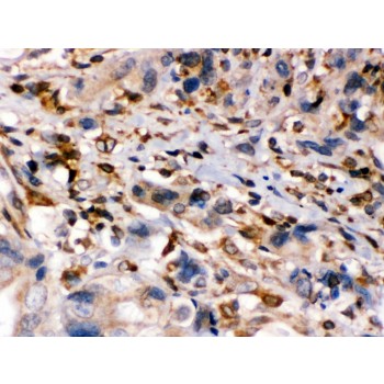 ABCB2 / TAP1 Antibody - TAP1 antibody IHC-paraffin. IHC(P): Human Intestinal Cancer Tissue.