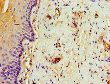 ABCB2 / TAP1 Antibody - Immunohistochemistry of paraffin-embedded human cervical cancer using antibody at 1:100 dilution.