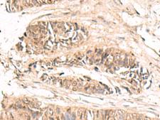 ABCB4 / MDR3 Antibody - Immunohistochemistry of paraffin-embedded Human colorectal cancer tissue  using ABCB4 Polyclonal Antibody at dilution of 1:70(×200)