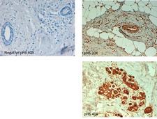 ABCB5 Antibody - Immunohistochemistry of rabbit anti ABCB5 antibody. Tissue: human breast carcinoma at pH6. Fixation: formalin fixed paraffin embedded. Primary antibody: ABCB5 antibody at 10 µg/mL for 1 h at RT. Secondary antibody: Peroxidase rabbit secondary antibody at 1:10,000 for 45 min at RT. Localization: ABCB5 is cytoplasmic. Staining: ABCB5 as precipitated brown signal with hematoxylin purple nuclear counterstain.