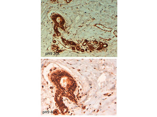 ABCB5 Antibody - Immunohistochemistry of rabbit anti ABCB5 antibody. Tissue: human breast carcinoma at pH9. Fixation: formalin fixed paraffin embedded. Primary antibody: ABCB5 antibody at 10 µg/mL for 1 h at RT. Secondary antibody: Peroxidase rabbit secondary antibody at 1:10,000 for 45 min at RT. Localization: ABCB5 is cytoplasmic. Staining: ABCB5 as precipitated brown signal.