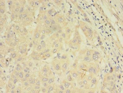 ABCB5 Antibody - Immunohistochemistry of paraffin-embedded human liver cancer using antibody at dilution of 1:100.