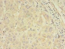 ABCB5 Antibody - Immunohistochemistry of paraffin-embedded human liver cancer using antibody at dilution of 1:100.
