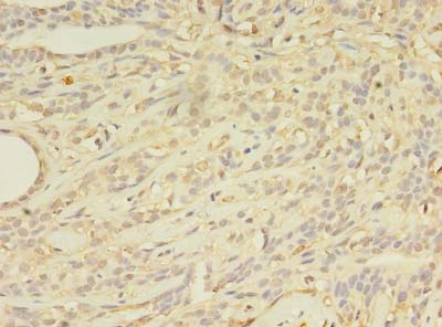 ABCB5 Antibody - Immunohistochemistry of paraffin-embedded human breast cancer using antibody at dilution of 1:100.