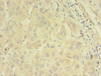 ABCB5 Antibody - Immunohistochemistry of paraffin-embedded human liver cancer using ABCB5 Antibody at dilution of 1:100