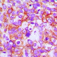 ABCB5 Antibody - Immunohistochemical analysis of ABCB5 staining in human breast cancer formalin fixed paraffin embedded tissue section. The section was pre-treated using heat mediated antigen retrieval with sodium citrate buffer (pH 6.0). The section was then incubated with the antibody at room temperature and detected using an HRP conjugated compact polymer system. DAB was used as the chromogen. The section was then counterstained with hematoxylin and mounted with DPX.