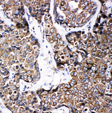 ABCB6 Antibody - ABCB6 antibody. IHC(P): Human Breast Cancer Tissue.