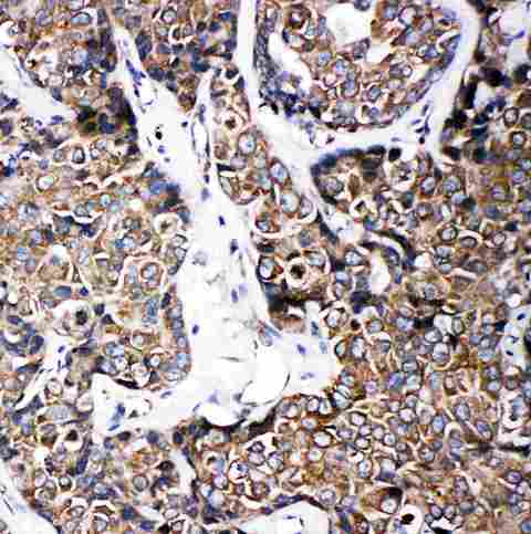 ABCB6 Antibody - Anti-ABCB6 antibody, IHC(P): Human Mammary Cancer Tissue