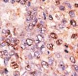 ABCB7 Antibody - Formalin-fixed and paraffin-embedded human cancer tissue reacted with the primary antibody, which was peroxidase-conjugated to the secondary antibody, followed by DAB staining. This data demonstrates the use of this antibody for immunohistochemistry; clinical relevance has not been evaluated. BC = breast carcinoma; HC = hepatocarcinoma.