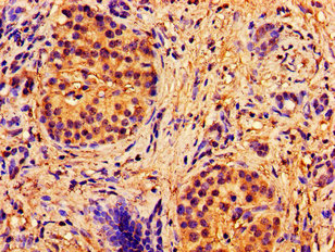 ABCB7 Antibody - Immunohistochemistry image of paraffin-embedded human pancreatic cancer at a dilution of 1:100