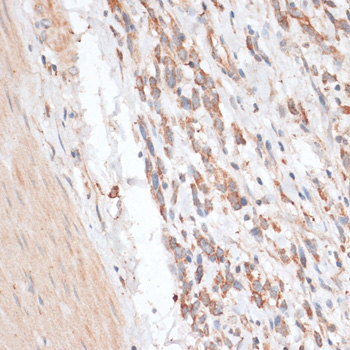 ABCB7 Antibody - Immunohistochemistry of paraffin-embedded human gastric cancer using ABCB7 antibody at dilution of 1:100 (40x lens).