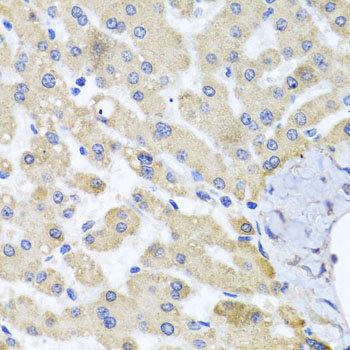 ABCB8 Antibody - Immunohistochemistry of paraffin-embedded human liver injury tissue.