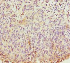 ABCB8 Antibody - Immunohistochemistry of paraffin-embedded human bladder cancer at dilution 1:100