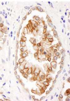 ABCB9 Antibody - Detection of Human ABCB9 by Immunohistochemistry. Sample: FFPE section of human prostate carcinoma. Antibody: Affinity purified rabbit anti-ABCB9 used at a dilution of 1:200 (1 ug/ml).