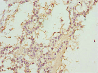 ABCC11 / MRP8 Antibody - Immunohistochemistry of paraffin-embedded human breast cancer at dilution 1:100
