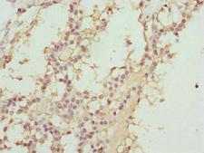 ABCC11 / MRP8 Antibody - Immunohistochemistry of paraffin-embedded human breast cancer at dilution 1:100