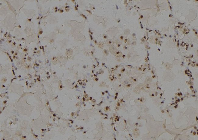 ABCC13 Antibody - 1:100 staining human lung tissue by IHC-P. The sample was formaldehyde fixed and a heat mediated antigen retrieval step in citrate buffer was performed. The sample was then blocked and incubated with the antibody for 1.5 hours at 22°C. An HRP conjugated goat anti-rabbit antibody was used as the secondary.