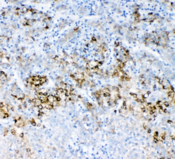 ABCC2 / MRP2 Antibody - IHC staining of FFPE human liver cancer with MRP2 antibody at 1ug/ml. HIER: boil tissue sections in pH6, 10mM citrate buffer, for 10-20 min and allow to cool before testing.