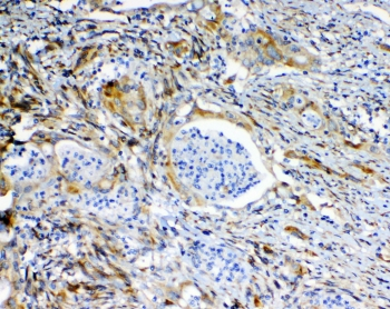 ABCC2 / MRP2 Antibody - IHC staining of FFPE human rectal cancer with MRP2 antibody at 1ug/ml. HIER: boil tissue sections in pH6, 10mM citrate buffer, for 10-20 min and allow to cool before testing.