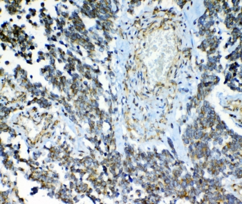 ABCC2 / MRP2 Antibody - IHC staining of FFPE human lung cancer with MRP2 antibody at 1ug/ml. HIER: boil tissue sections in pH6, 10mM citrate buffer, for 10-20 min and allow to cool before testing.