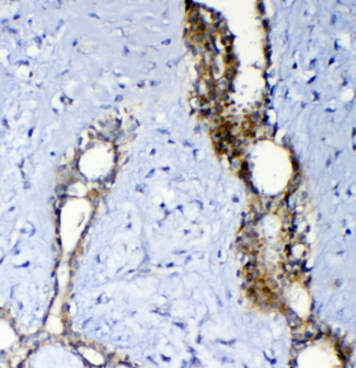 ABCC2 / MRP2 Antibody - IHC staining of FFPE human breast cancer with MRP2 antibody at 1ug/ml. HIER: boil tissue sections in pH6, 10mM citrate buffer, for 10-20 min and allow to cool before testing.