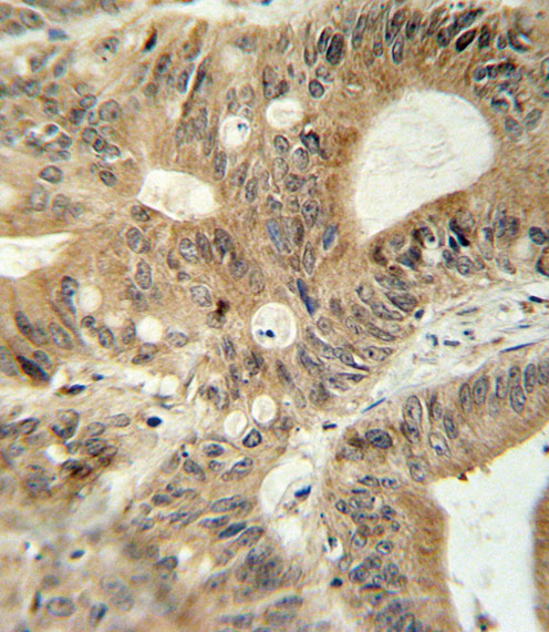 ABCC3 / MRP3 Antibody - ABCC3 antibody immunohistochemistry of formalin-fixed and paraffin-embedded human colon carcinoma followed by peroxidase-conjugated secondary antibody and DAB staining.