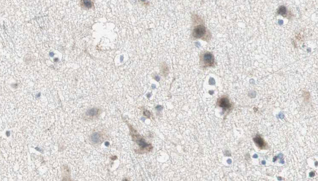 ABCC3 / MRP3 Antibody - 1:100 staining human brain carcinoma tissue by IHC-P. The sample was formaldehyde fixed and a heat mediated antigen retrieval step in citrate buffer was performed. The sample was then blocked and incubated with the antibody for 1.5 hours at 22°C. An HRP conjugated goat anti-rabbit antibody was used as the secondary.