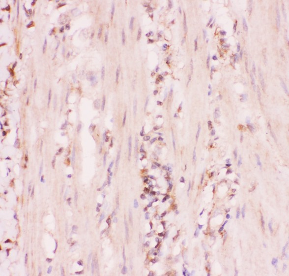 ABCC4 / MRP4 Antibody - MRP4 antibody IHC-paraffin: Human Intestinal Cancer Tissue.