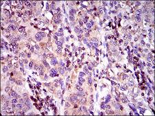 ABCC4 / MRP4 Antibody - IHC of paraffin-embedded endometrial cancer tissues using ABCC4 mouse monoclonal antibody with DAB staining.