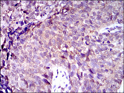 ABCC4 / MRP4 Antibody - IHC of paraffin-embedded bladder cancer tissues using ABCC4 mouse monoclonal antibody with DAB staining.