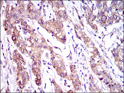 ABCC4 / MRP4 Antibody - IHC of paraffin-embedded liver cancer tissues using ABCC4 mouse monoclonal antibody with DAB staining.