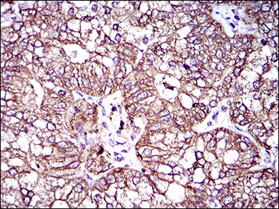 ABCC4 / MRP4 Antibody - IHC of paraffin-embedded esophagus cancer tissues using ABCC4 mouse monoclonal antibody with DAB staining.