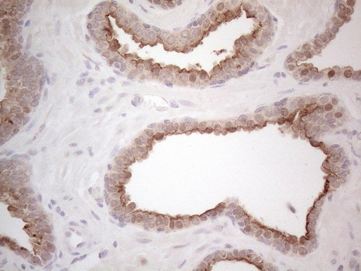 ABCC5 / MRP5 Antibody - Immunohistochemical staining of paraffin-embedded Carcinoma of Human prostate tissue using anti-ABCC5 mouse monoclonal antibody. (Heat-induced epitope retrieval by 1mM EDTA in 10mM Tris buffer. (pH8.5) at 120°C for 3 min. (1:150)